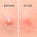 Rael Pimple Patches, Miracle Invisible Spot Cover - Hydrocolloid Acne Pimple Patch, Absorbs Zits & Blemish, Korean Skin Care, 2 Sizes (96 Count) - Image 5